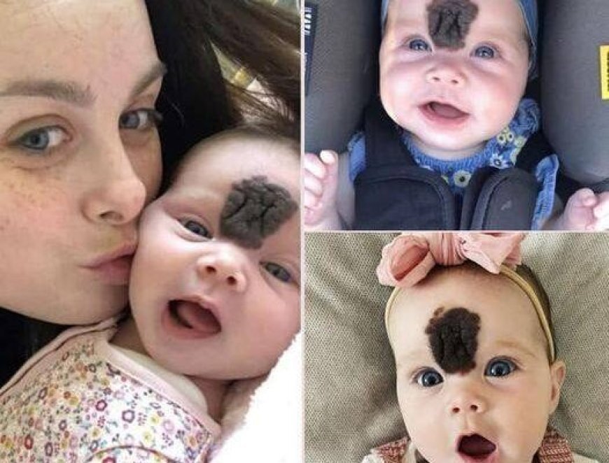 A Mom’s Heartwa,rming Journey to Remove Her Daughter’s Birthmark